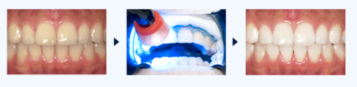 ホワイトニング術中